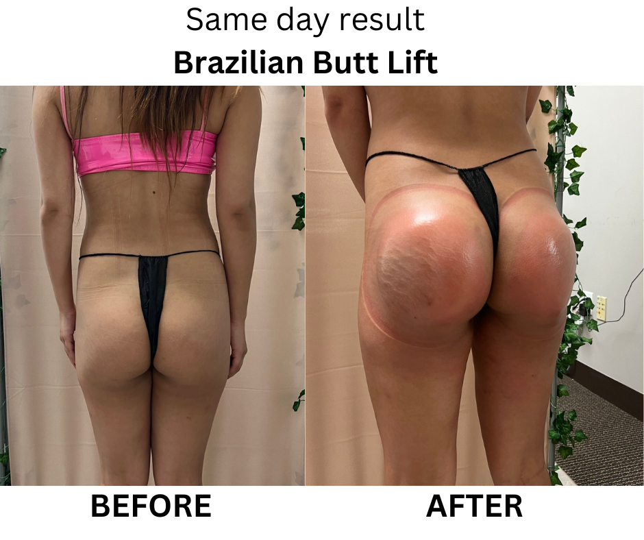 non surgical bbl before and after in san fernando valley by prestigious body contouring