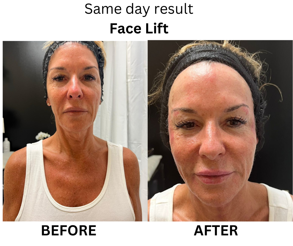 Before & After - Facelift