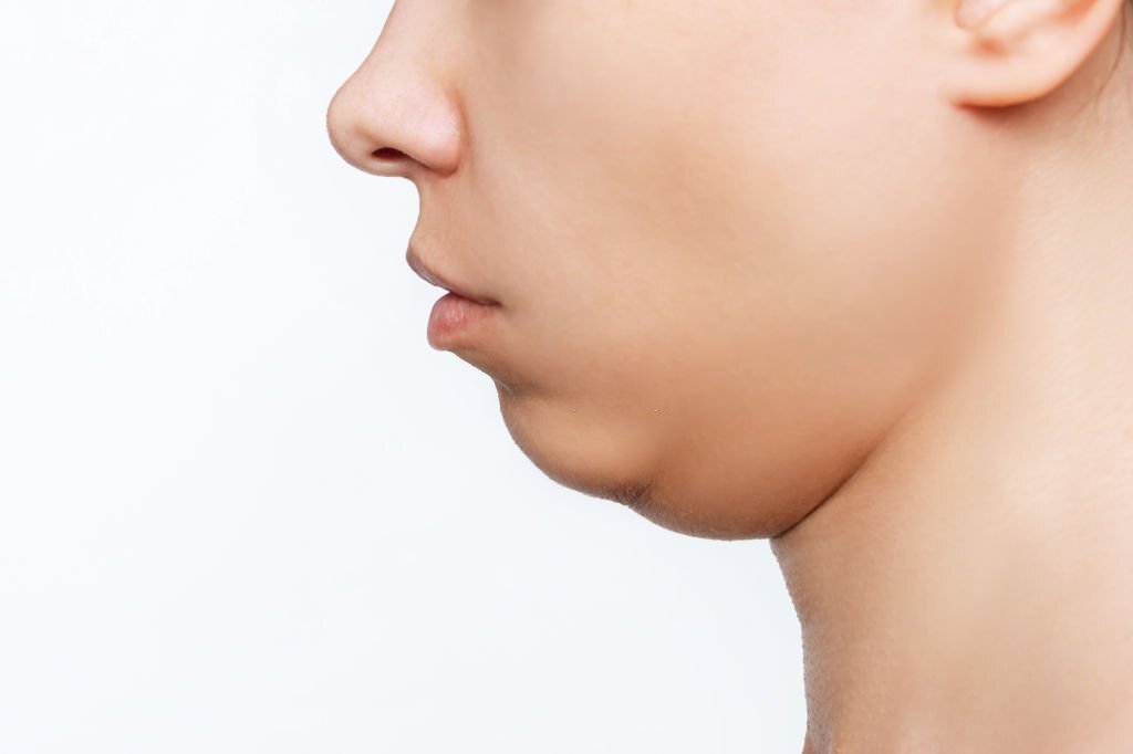 double chin