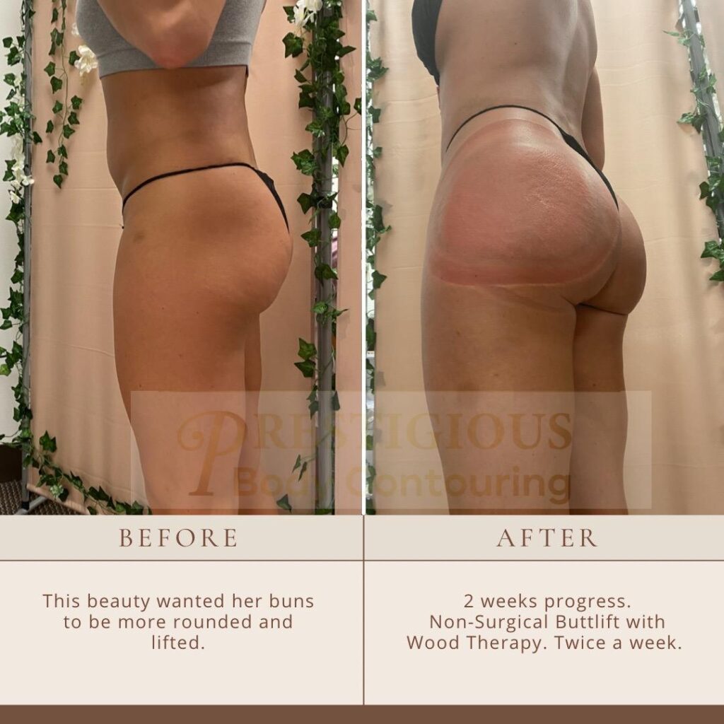 bbl before and after in la by prestigious body contouring