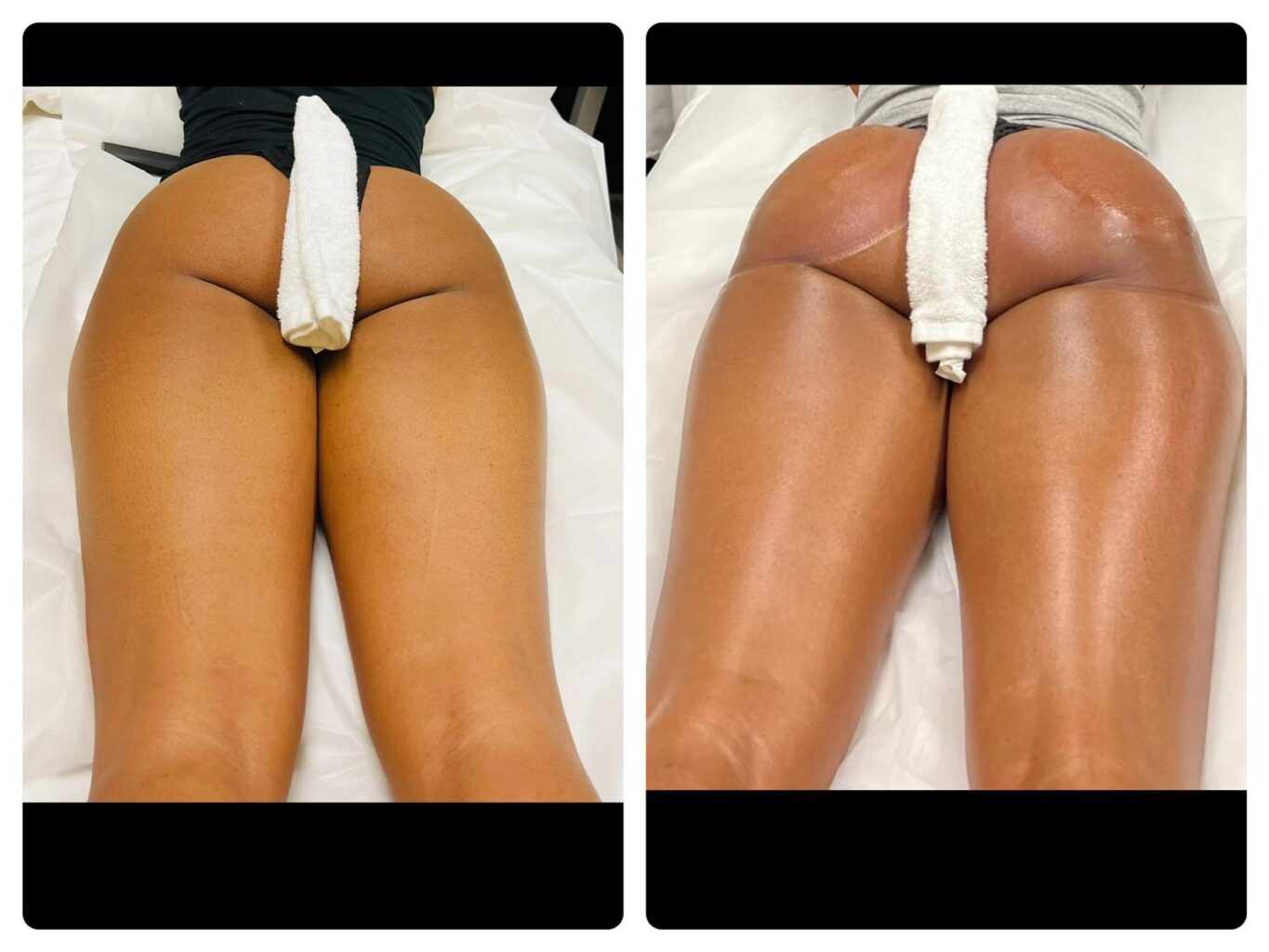 non surgical butt lift before and after in Los angeles by prestigious body contouring
