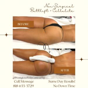 non-surgical buttlift + cellulite