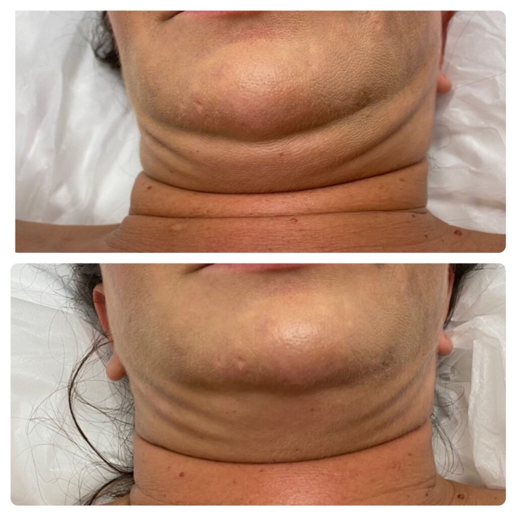 non surgical double chin removal service in LA