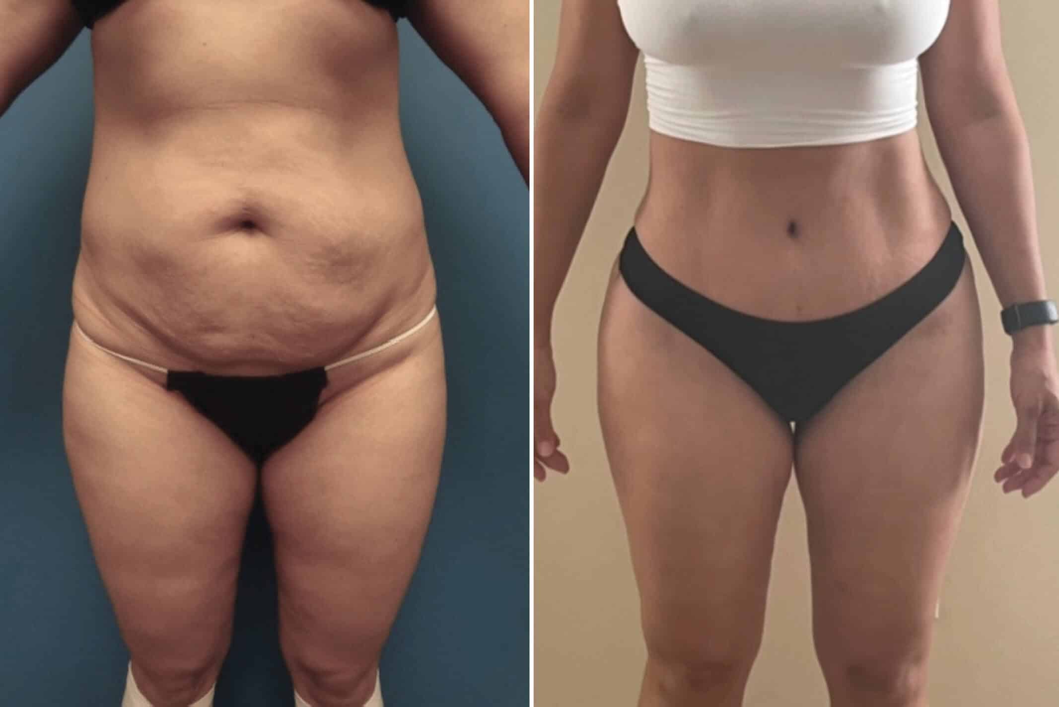 Our Before & After Body Sculpting Results in LA