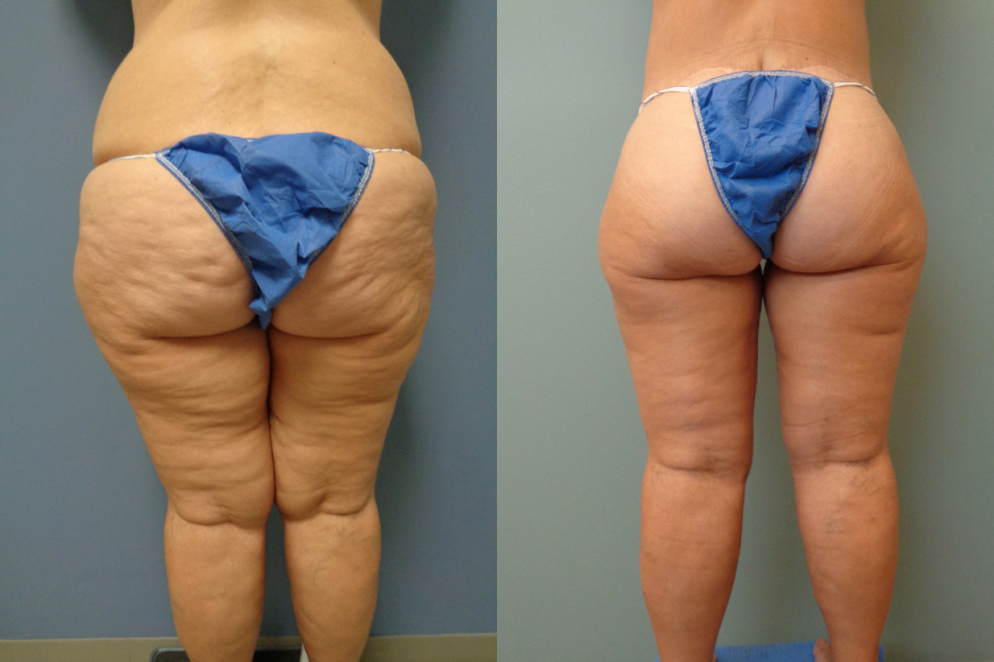non surgical butt lift before and after by prestigious body contouring