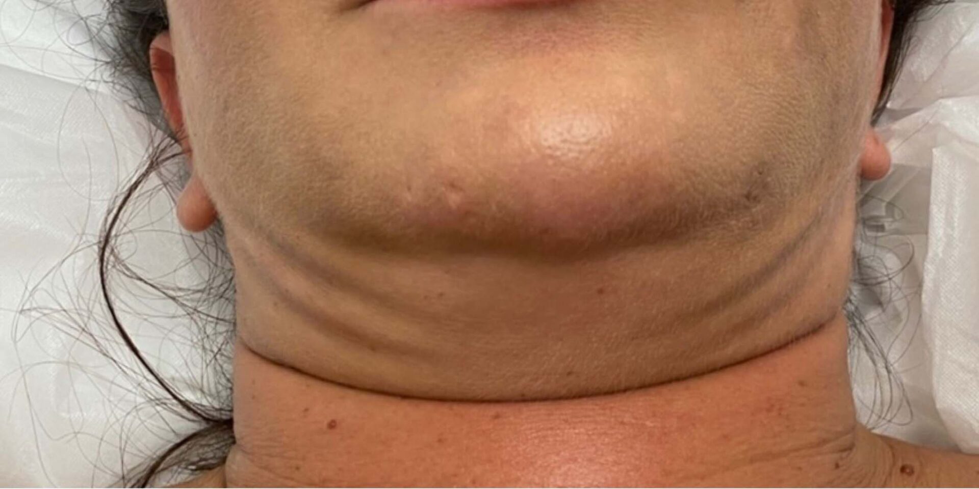 after double chin reduction by prestigious body contouring