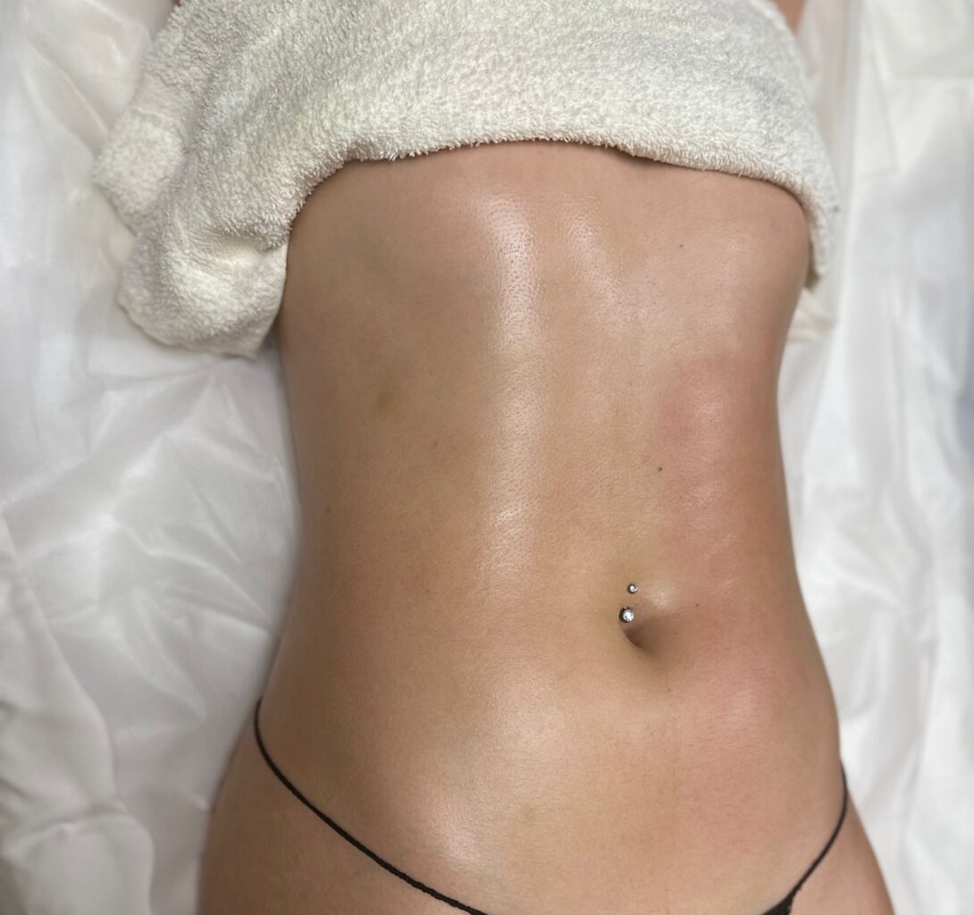 after laser lipo scultping package at prestigious body contouring