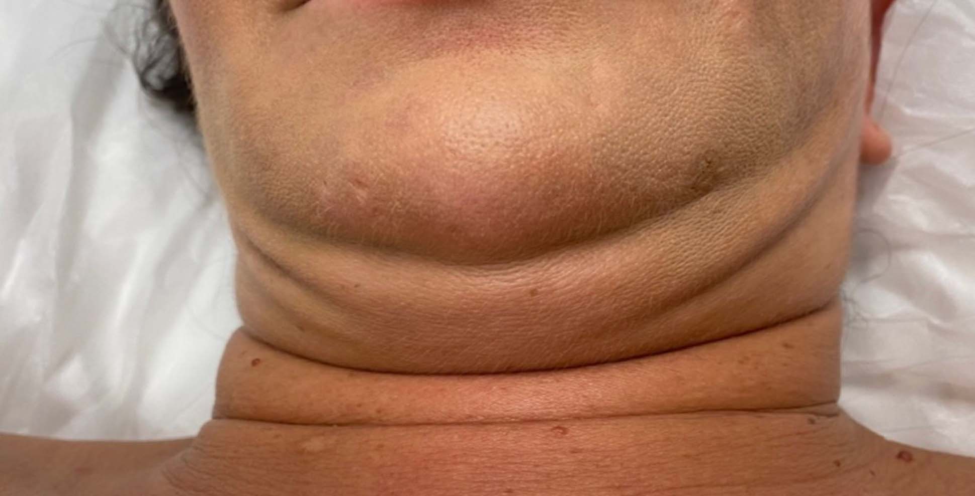 before double chin reduction by prestigious body contouring