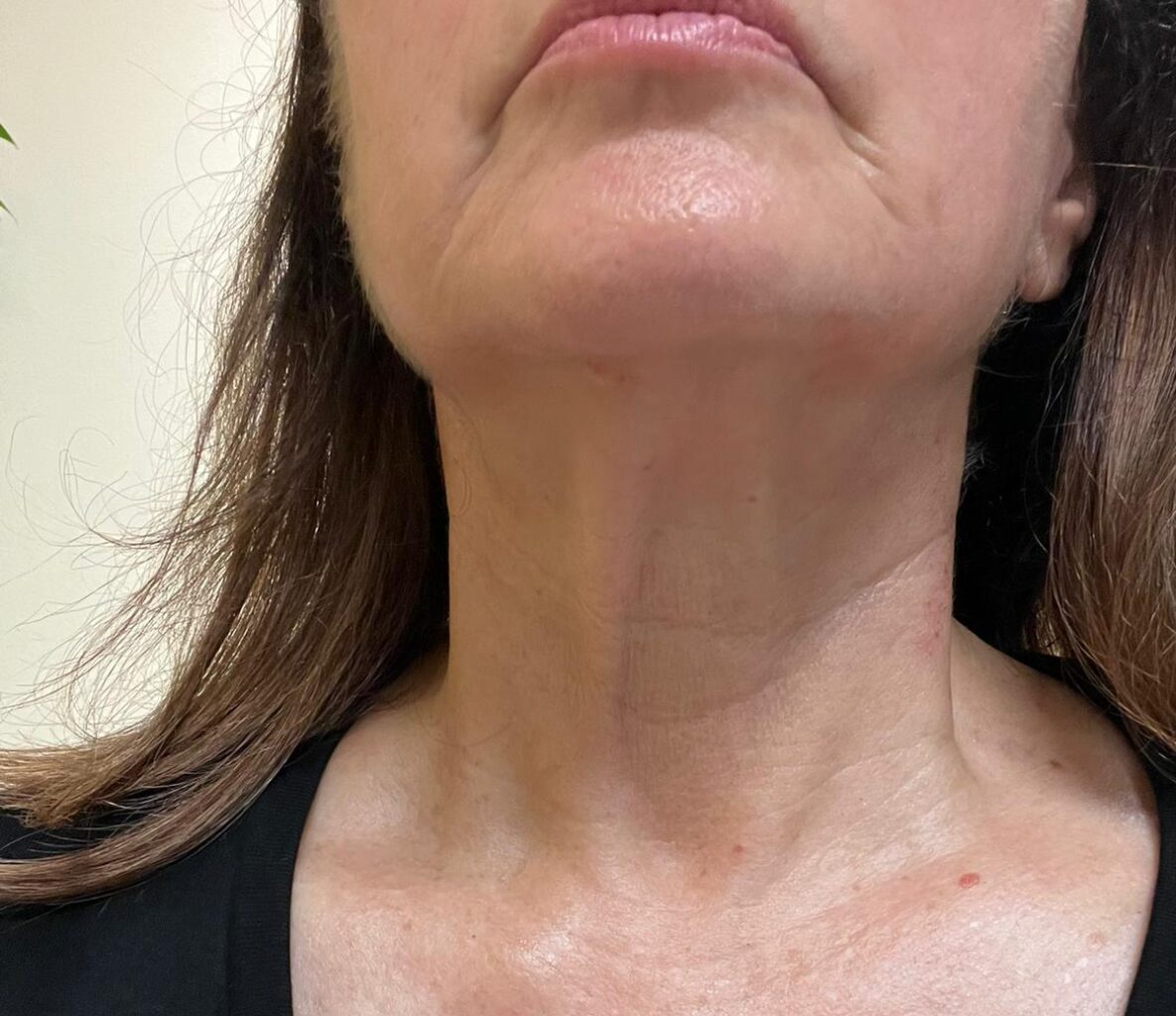 double chin removal by prestigious body contouring