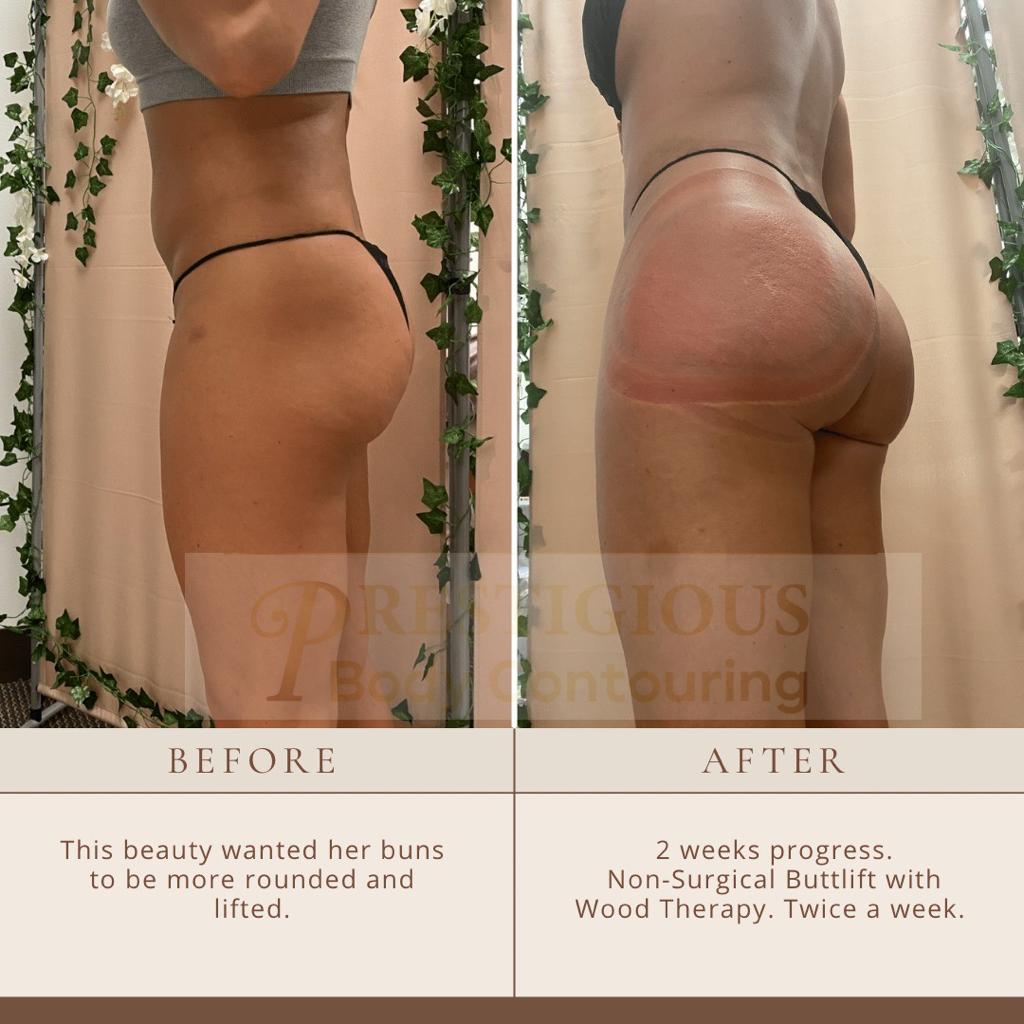 cupping buttocks before and after
